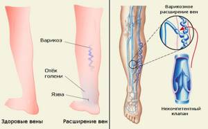 варикозное расширение вен на ногах симптомы и лечение диета