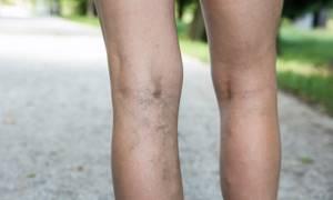 варикозное расширение вен на ногах симптомы и лечение лекарства