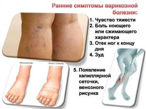 варикозное расширение вен на ногах симптомы и лечение после беременности