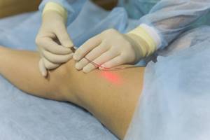 варикозное расширение вен на ногах симптомы и лечение после операции