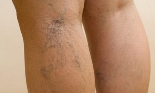 варикозное расширение вен на ногах симптомы и лечение уколы