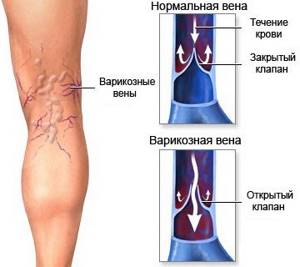 варикозное расширение вен на ногах симптомы и лечение врач
