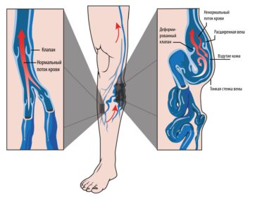 варикозное расширение вен на ногах симптомы лечение в домашних условиях