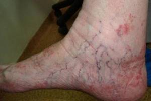 варикозное расширение вен на ногах стадии симптомы и лечение