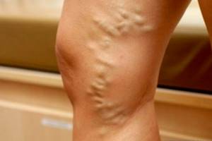 варикозное расширение вен на ногах степени симптомы и лечение