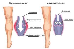 варикозное внутреннее расширение вен на ногах симптомы и лечение