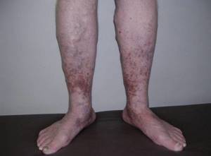 варикозное внутреннее расширение вен на ногах симптомы и лечение