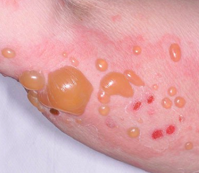 вирусная пузырчатка у детей симптомы лечение