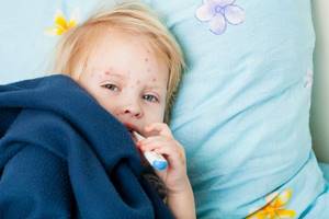 вирусная пузырчатка у детей симптомы лечение