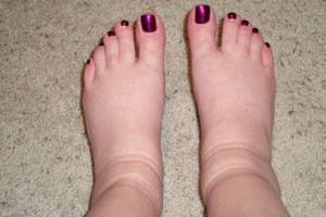внутренний варикоз на ногах симптомы и лечение