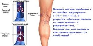 внутренний варикоз вен на ногах симптомы и лечение