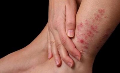 воспаление кожи ноги симптомы и лечение