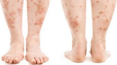 воспаление кожи ноги симптомы и лечение