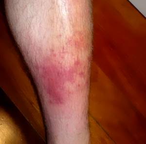 воспаление мышц ноги симптомы и лечение в домашних условиях