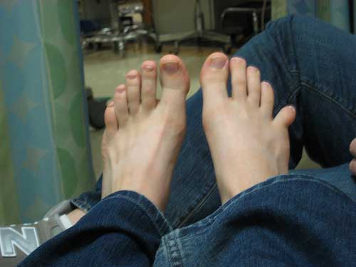 вывих большого пальца ноги симптомы лечение