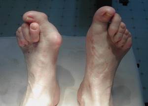 вывих большого пальца ноги симптомы лечение