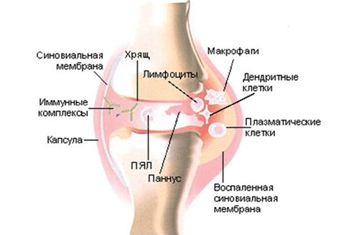заболевание суставов на ногах симптомы и лечение