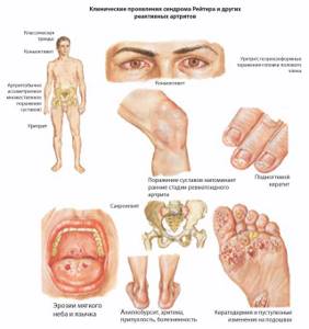заболевание суставов на ногах симптомы и лечение