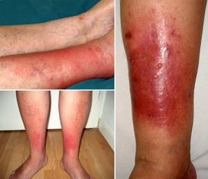 заразно ли рожистое воспаление ноги симптомы и лечение