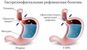 желудочный кашель симптомы и лечение народными
