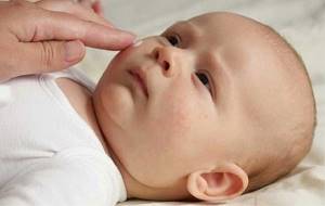 атопический дерматит у ребенка симптомы и лечение