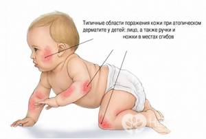 атопический дерматит у ребенка симптомы и лечение