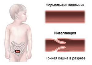 кишечная непроходимость симптомы лечение у детей