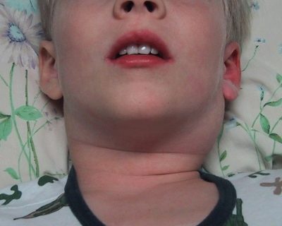лимфоузлы воспаление симптомы лечение у детей